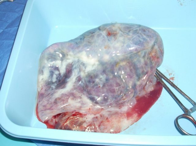 placenta-202640_1280