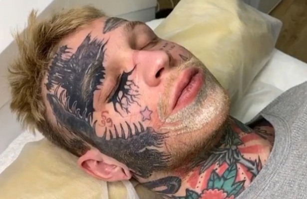 Как выглядит сын елены яковлевой после удаления татуировки лазером фото